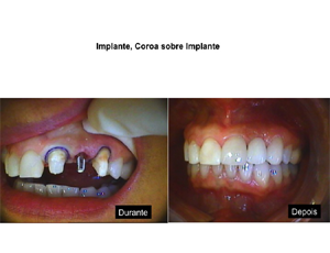 coroa_sobre_implante